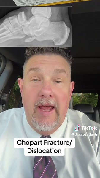 Understanding Chopart Fractures and Dislocations