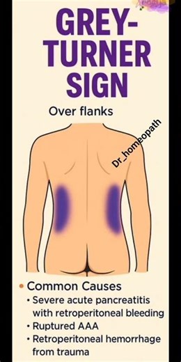 grey turner sign #pancreatitis #clinical