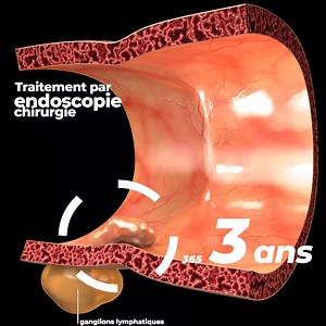 [#prévention]⏳ Parce que quelques images valent parfois mille discours : notre vidéo pour bien illustrer l’évolution d’un cancer qui n’est pas détecté et donc traité au plus tôt (ici un cancer du côlon). ℹ️ Parfois sans symptômes apparents et donc sans signaux d’alerte dans un premier temps, le cancer est souvent pris en charge trop tardivement. Pourtant plus tôt il est détecté, moins il se dissémine, plus faibles sont les dégâts qu’il cause, et beaucoup plus fortes sont les chances de l’extrair