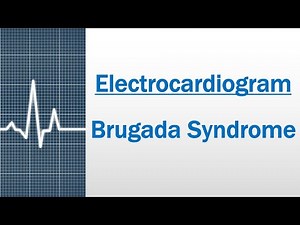 Brugada Syndrome - Pathophysiology, Diagnostic criteria and Management [Electrocardiogram]