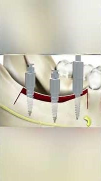 “Crestal Bone Splitting and Expansion Technique in Implant Dentistry” #dentist #implant