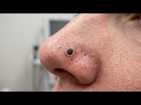 What Was Hiding Inside These Nose Pores? | Deep Blackhead Cleanup
