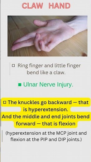Claw Hand Explained in 60 Seconds | Ulnar Nerve Injury Made Easy