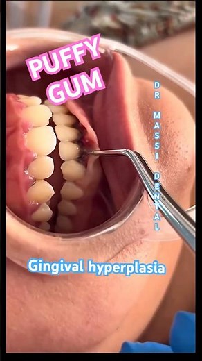 Gingival hyperplasia , Gum Overgrowth