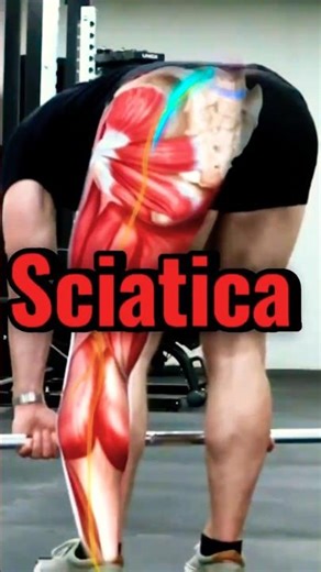 Leg pain shooting down? Do this quick 10-sec sciatica test — results are instant.