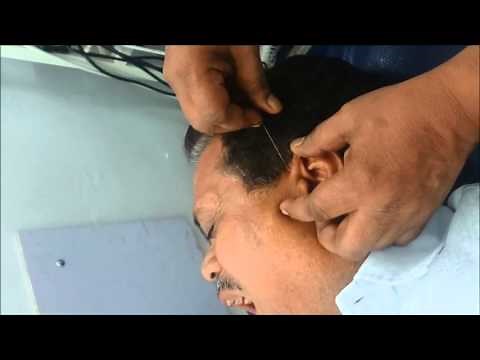 Acupuncture successful treatment for Deafness and Tinnitus