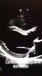 8.6K views · 175 reactions | Parachute mitral valve (PMV) is defined as a unifocal attachment of the mitral valve chordae to a single or dominant papillary muscle and may cause subvalvar obstruction | Dr M Jahangeer Sarwar Cardiologist | Facebook