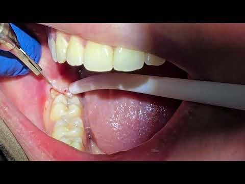 Surgical extraction of a vertical lower right wisdom tooth with soft tissue impaction