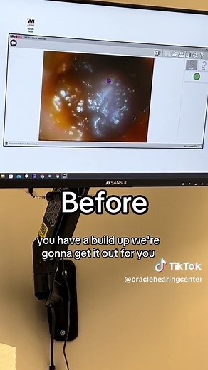 Successful Earwax Removal Procedure at Oracle Hearing Center