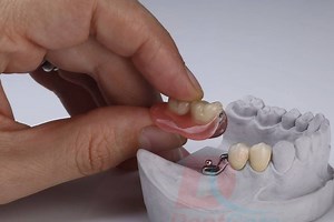 3.4K views · 60 reactions | Precision Attachments from DentCare. | DentCare | Facebook