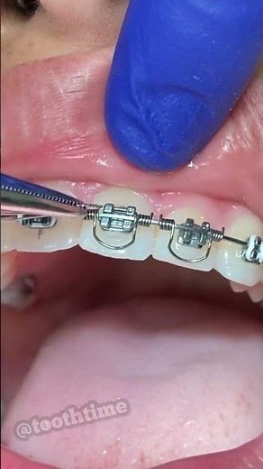 Torque Springs Orthodontics - Braces On - Tooth Time Family Dentistry New Braunfels