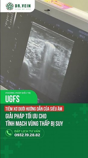 UGFS: Solution for treating incompetent saphenous veins in the lower leg