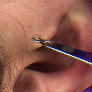 Blackhead Removal Kit: ‪https://amzn.to/2EUJpcv‬ RESTMORE (30 Day): ‪https://amzn.to/2EULvZT‬ Thinergy: ‪https://amzn.to/2Tl9GJU‬ Thinergy (3 Pack): ‪https://amzn.to/2ToWxQ1‬ Teeth Whitening Pens: https://amzn.to/2CaxYvL #pimplepops #dermatologyvideos #medical #blackheadremoval #cysticacne #mrblackhead #dermatology #poppers #pimplepoppers #popaholics #drpimplepopper #drpopper #medicalvideos #medicine #zit #comedones #dilatedpores #dilatedporeofwiner #comedoneextractor | CystBursting.com