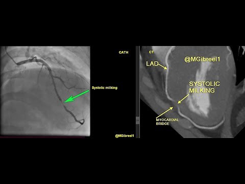Systolic milking of a deep myocardial bridge of the late mid-LAD CT & Cath