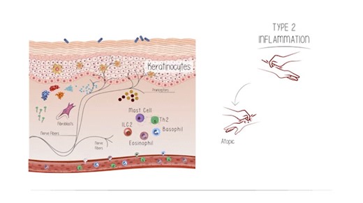 In the eighth Installation, Dr. Brian S. Kim compares the shared and distinct pathophysiological features of Itch across AD, PN, and CSU. He ties together the knowledge from earlier discussions, highlighting the similarities and differences in the mechanisms of itch across the diseases. Watch here: https://thedermdigest.com/videos/understanding-the-role-of-type-2-inflammation-in-itch-across-atopic-dermatitis-prurigo-nodularis-and-chronic-spontaneous-urticaria/?vimeography_gallery=52&vimeography_