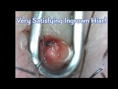 Heavily Infected Ingrown Hair Microscopic Removal!!! (WARNING: BLOOD SHOWN)