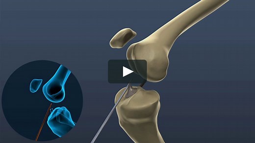 LARS™ ACL - Surgical Technique