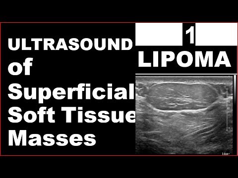 Lipoma on Ultrasound