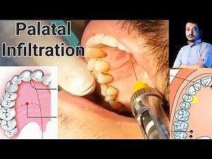 Local Anesthesia, Palatal Infiltration Technique, Maxillary Anesthesia Techniques #dentistry