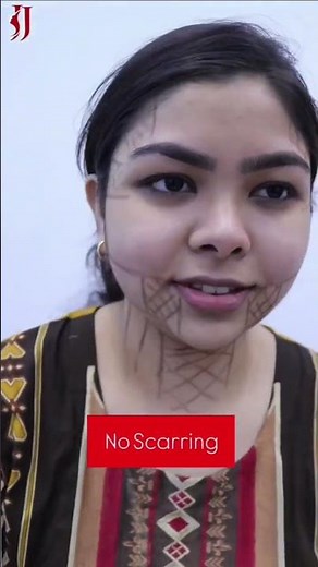 Hifu Results | 7D Hifu Before & After | Face Contour Treatment | JJ Aesthetics