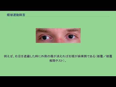 眼球運動障害