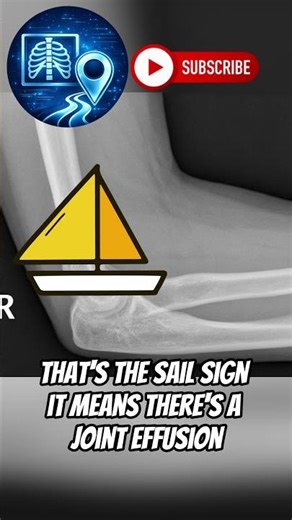 STOP. You’ll Miss This Elbow Fracture