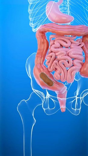 Poop Blocks Your Intestine 😱 #facts #fact #knowledge #factsdaily #didyouknow #love #dailyfacts #science #amazingfacts #instagram #factsoflife #factz #truth #motivation #india #knowledgeispower #gk #interestingfacts #generalknowledge #sciencefacts #instafacts #education #funfacts #didyouknowfacts #life #factsonly #upsc #memes #quotes #factsonfacts | Nexa 3D Facts