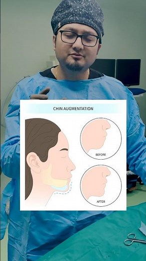 Chin Implant Explained in 30 Seconds | Face Transformation