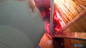 Anterior Supine THA without Table Extension