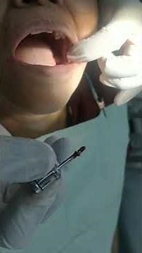placement of healing cap after implants