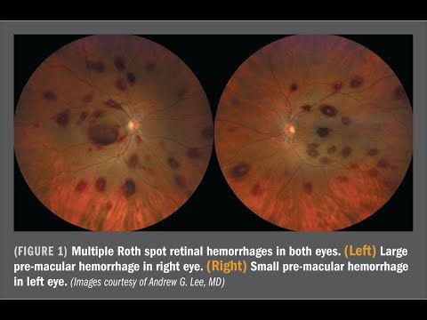 Roth’s spots retinal haemorrhages; seen on fundoscopic examination