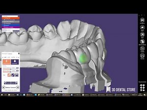 exocad : Modélisation