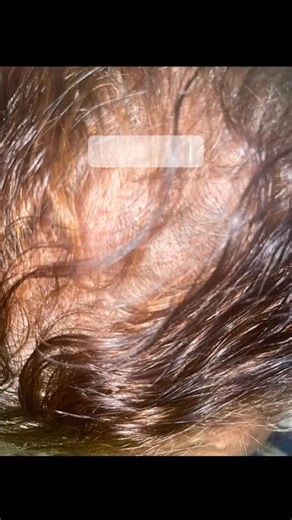 ‎سنتر ريفال لانبات الشعر Revival Center – Hair Restoration‎ on Instagram‎: "#تكثيف_الشعر #علاج_الفراغات #فراغات_الشعر #تساقط_الشعر"‎