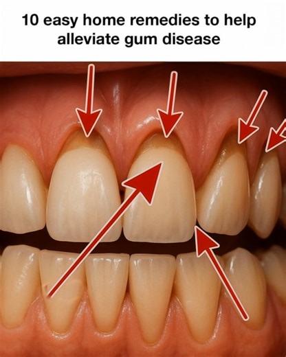 Dentists won’t tell you this — but these 10 simple home remedies can calm swollen gums, ease pain, and help fight gum disease faster than you think. 👇🦷 | Useful Tips