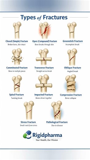 11 Types of Bone Fractures Explained in 60 Seconds 🦴 | मेडिकल Knowledge You Must Know! | Rigidpharma