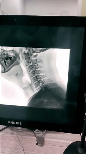 Swallow Study (VFSS) atau Modified Barium Swallow Study (MBSS)