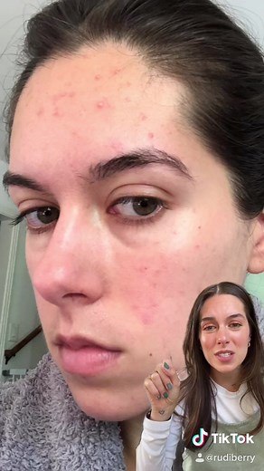 Here are the signs of a broken skin barrier and how to help it! 💕