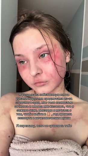 Такая вот история… выдержала, никуда не вышла 🙏 #синдромотменыгормона #topicalsteroidwithdrawal #tsw #сотк #атопическиймдерматит