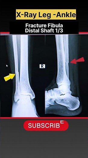 Fracture Fibula bone | x-ray Leg with ankle #xray #shorts