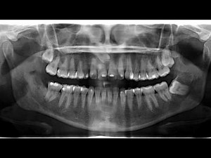 TADS and Invisalign technique to solve crowding