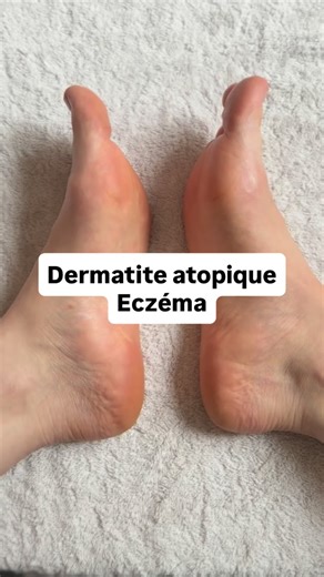 En cas de dermatite atopique, eczéma, voici une technique naturelle à mettre en place tous les jours si besoin, et toujours en complément des conseils de votre médecin. À bientôt ! | Lucie Blondel - Réflexologue Titre RNCP & Conseil en aromathérapie