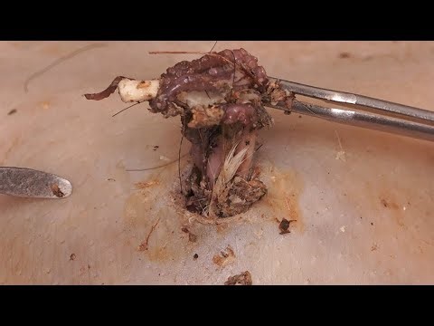 DR LEE’S ULTIMATE ZITPOPPERA achieve Inner Peace with Botfly Removal | Sharp Ingrown Trimmed JGK B24