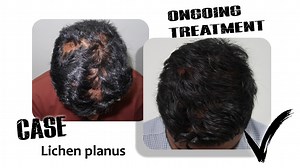 1.8K views | Here is a case of Lichen planus, which scars the scalp and makes it itchy due to inflammation! Let's watch the clip for more insight on how it's managed. #hairgrowth #haircare #hairrestoration #hairlosssolution #alopecia #lichenplanus #confidence | Hair Hub-The Trichology Centre | Facebook