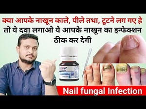 Best medicine for nail fungal infection | Best cream for Fungal infection in Fingernail & Toenails
