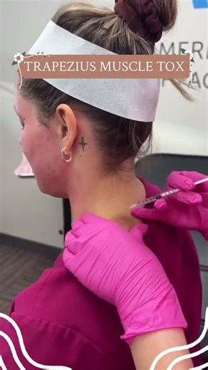 Trapezius Muscle Tox