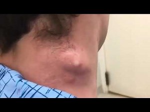 How to pop a giant boil on back, pimple & cyst popping this week, blackheads, zits and acne treatmen