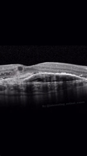 Finding on this scan are: 1.CNVM with adjacent leakage 2.Drusen 3.Exudates 4.Intraretinal fluid. https://youtube.com/@dr-muzamilhussainbaloch?si=iJfdaZghDTkFANMk | Dr-Muzamil Hussain Baloch