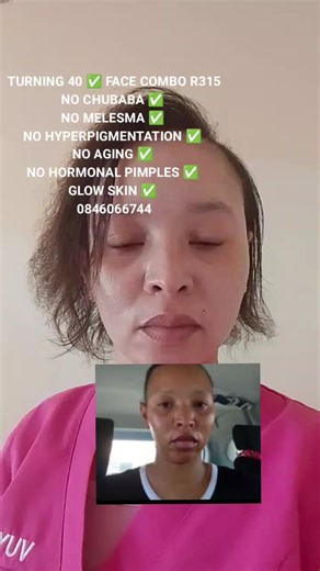 Effective Solutions for Hormonal Acne and Hyperpigmentation