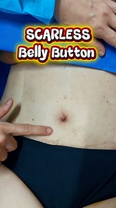 49 reactions | The Scarless Belly Button Tummy tuck! Which would you choose? #hubogroura #thefatsucker #scarlessbellybutton #hourglasstummytuck #vaserlipoph | ROURA Aesthetic Institute | Facebook