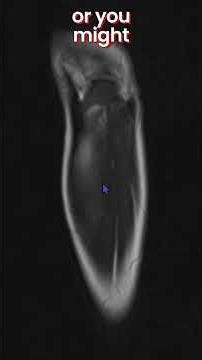CT/X-ray- 1 MR- 0 !! #msk#radiology #mri #case#bone#tumor#osteoid#child#pain#night#ct#xray#anatomy